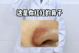 鼻子总是红红的，医生教你正确处理 #脂溢性皮炎 #敏感肌 #护肤 #女生必看 #硬核健康科普行动视频封面