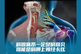 肩周痛不一定是肩周炎，可能是肩胛上神经卡压综合征视频封面