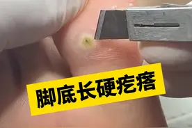 脚底板硬硬的小疙瘩，当心是#hpv  感染引起的！#跖疣 #瘊子  #科普视频封面