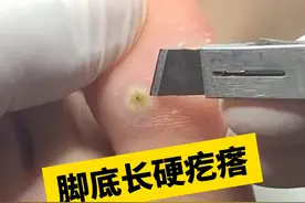脚底板硬硬的小疙瘩，当心是#hpv  感染引起的！#跖疣 #瘊子  #科普视频封面