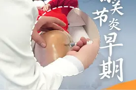 膝关节炎膝关节疼痛，一条视频讲清，你是否适合注射玻璃酸钠？ #硬核健康科普行动 #硬核健康科普 #膝关节 #膝关节疼痛  #膝关节炎视频封面