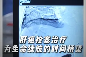 肝癌栓塞治疗：为生命续航的时间桥梁！ #昆明市第三人民医院视频封面