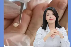 长了鸡眼千万别去挖！教你一招简单处理#医学科普 #鸡眼 #鸡眼去除小妙招 #皮肤