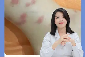 如果你最近身上出现了又痒又红的大包，这可能是蠓虫咬的！！千万别抓挠，会留黑印子。#科普健康知识   #蠓虫   #蚊子包   #虫咬皮炎   #痒