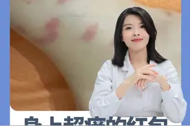 如果你最近身上出现了又痒又红的大包，这可能是蠓虫咬的！！千万别抓挠，会留黑印子。#科普健康知识   #蠓虫   #蚊子包   #虫咬皮炎   #痒视频封面
