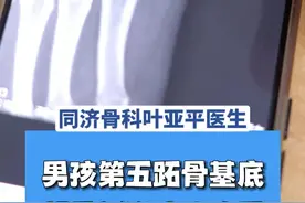 男孩第五跖骨基底部骨折,超过三周了错过了黄金期 #医学科普 #第五跖骨基底部骨折 #骨折 #硬核健康科普行动视频封面
