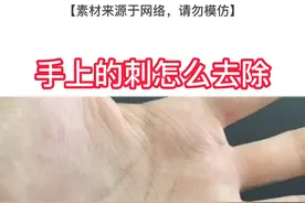 #手上的刺怎么去除小妙招 #科普 #辟谣 #dou来说健康 #皮肤 #健康 视频封面