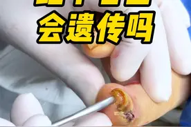 趾甲卷曲会遗传吗 #嵌甲矫正术 #甲沟炎 #嵌甲 #硬核健康科普行动视频封面