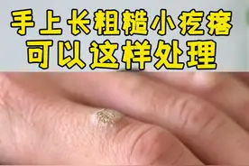 手上长了黄豆大小的硬疙瘩，这样处理是比较快的#健康 #科普#好东西一起分享 视频封面
