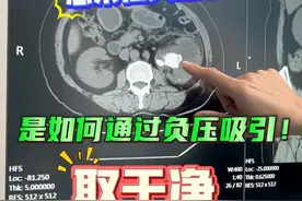 感染性大结石，通过负压吸引技术取干净 #肾结石 #输尿管狭窄 #微创手术 #硬核健康科普行动  #医疗健康创作训练营视频封面