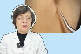 #脖子上长小肉粒 要当心！这是#病毒感染 ，小心传染给家人#丝状疣 #硬核健康科普行动  #夫妻视频封面