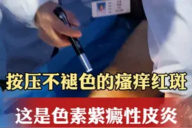 按压不褪色的瘙痒红斑，这是色素紫癜性皮炎 #皮炎 #中医皮肤科主任张颜 #中医 #医学科普 #色素性紫癜