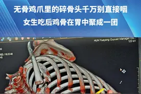 无骨鸡爪里的碎骨头千万别直接咽，女生吃后鸡骨在胃中聚成一团（来源：@不可不可乐 ）#无骨鸡爪视频封面
