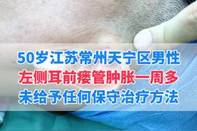 家里五个人都有耳前瘘管#医学科普 #耳前瘘管 #硬核健康科普行动  #武汉陈金辉视频封面