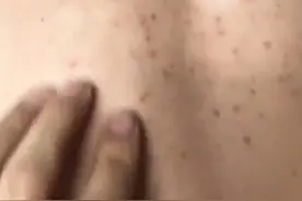 前胸后背长很痒的小疙瘩，别再挠了，这可能是#马拉色菌毛囊炎 ，要对症处理。#前胸后背痘#毛囊炎#痒#痘痘视频封面