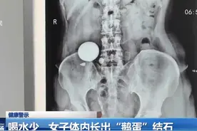 喝水少 女子体内长出“鹅蛋”结石视频封面