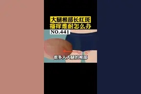 大腿内侧长红斑，难以启齿，以为是性病？其实#科普 #股癣 #联苯苄唑喷雾 视频封面