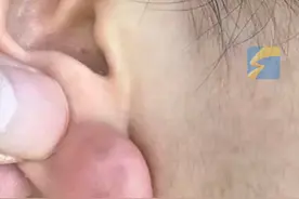 女子打耳洞半年后 耳垂长出“鸽子蛋”大的肿块 医生：疤痕体质的人最好别打耳洞视频封面