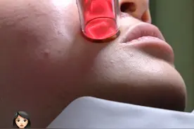 皮肤科医生破皮医美项目术后护理全流程！医美小白来抄作业～ #人表皮生长因子凝胶#医美#点阵激光#毛孔粗大#护肤视频封面