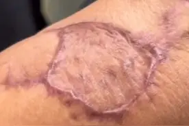 植皮瘢痕怎么去除？ #医学科普 #瘢痕 #瘢痕修复 #植皮 #植皮疤痕视频封面