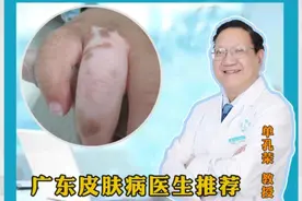 身体哪些部位容易出现白斑问题？ #健康知识科普  为什么白癜风容易出现在手上、脸上和肚皮上？ #广东白癜风医生推荐   #单孔荣医生   #挂单孔荣号 #硬核健康科普行动视频封面