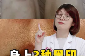 身上这3种黑印，一个30s的视频教你处理#黑印 #皮肤 #科普 #蚊子 #变美