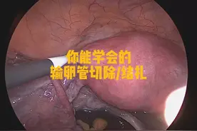 最简单的输卵管切除/结扎 你们能学会吗#硬核健康科普行动