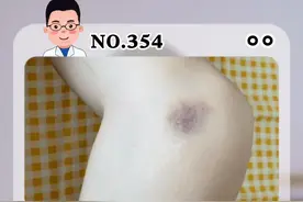 明明什么都没碰，膝盖就莫名出现淤青的痕迹，你有过这种情况吗？#医学科普#dou来涨健康知识 视频封面