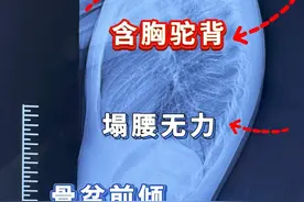 儿童青少年不良体态矫正锻炼指南与方法精选大合集！ #耸肩驼背 #脖子前倾 #4至8岁儿童锻炼  #不良体态 #抖出健康知识宝藏