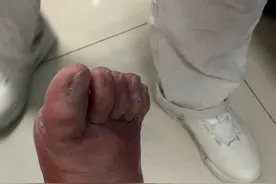 糖尿病8年，血糖控制不佳，脚开始流脓破溃，有截肢风险。视频有点长，但是希望你耐心看完，特别是身边有#糖尿病 的朋友#糖尿病足 #医学科普 #硬核健康科普行动视频封面
