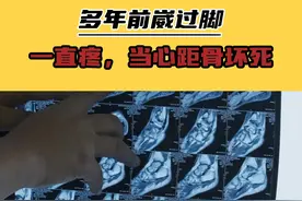多年前崴过脚，近期一直疼，当心是距骨坏死越来越重 #医学科普 #硬核健康科普行动视频封面
