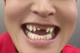 男子啃甘蔗时发生尴尬一幕，两颗假牙掉进了甘蔗里……女儿在旁边提醒：爸爸，你的牙掉了！#尴尬时刻 #啃甘蔗 #假牙掉了 （来源：@陈少洪 ）视频封面