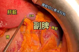 副脾，今天它来了#副脾 #先天性结构 #医学科普