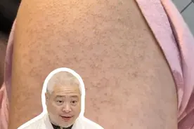 手臂、大腿上这些麻麻赖赖，皮肤科医生教你解决#鸡皮肤 #硬核健康科普行动  #入冬换季不患疾  #医学科普 #皮肤干燥视频封面