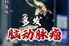 这位68岁的女性患者是因#头晕 #头痛 ，在门诊做了CTA，诊断出了左侧颈内动脉瘤的多发动脉瘤，对于这种情况，一般常规方法是用支架辅助弹簧圈栓塞，一个个栓，这种方式不仅要用到多个支架，且当某些动脉瘤比较小的时候，难以超选，因此我们目前一般是选择密网支架进行治疗#脑动脉瘤 #神外脑血管病专家潘力主任 #硬核健康科普行动  @抖音医疗健康小助手视频封面