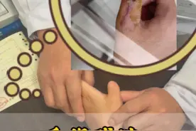 手指残缺，手指再造后复查 #手指残缺 #再造 #硬核健康科普行动 @DOU+小助手 @抖音健康使用计划 @抖音创作者中心视频封面