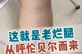 大姐从呼伦贝尔远道而来，静脉曲张已经导致老烂腿，别担心，这也能治。#静脉曲张 #静脉曲张彭军路主任 #医大一院静脉曲张微创诊疗中心 #河北医大一院血管外科团队 #硬核健康科普行动视频封面
