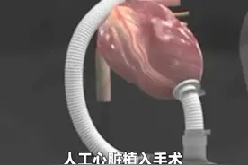 山东省首例人工心脏植入患者今天（1月13日）在青岛顺利出院。  #山东 #人工心脏视频封面