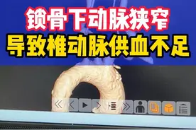 锁骨下动脉狭窄，怎么就造成椎动脉供血不足了呢？视频封面