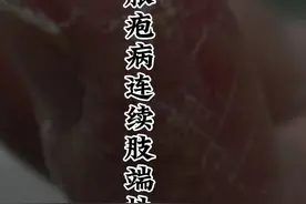 连续指端性皮炎与掌跖脓疱病如何区分呢？ #连续指端性皮炎 #掌跖脓疱病 #医学科普 #干货分享视频封面