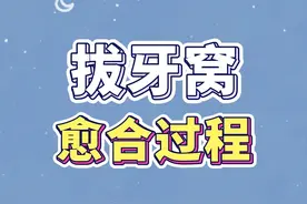 拔牙后，什么样的拔牙窝是正常的？ #拔牙 #医学科普 #牙医日常 #新年愿望吃好玩好视频封面