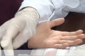 如何根据肌体病症表现判断渐冻症？肌肉萎缩，舌肌萎缩，这是判断渐冻症的重要依据之一！#渐冻症 #疑难病刘友章教授 #运动神经元病 #硬核健康科普行动 #硬核健康科普dou来说视频封面