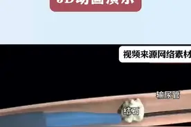 输尿管取石过程3D动画演示 #硬核健康科普行动 #肾结石 #医学科普视频封面