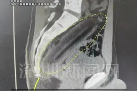 【#男子为治便秘将15cm黄瓜塞进肛门无法取出】#江苏dou知道视频封面