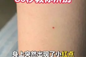 停一停！来看看你是哪种小红点？ #樱桃状血管瘤  #朱砂痣  #出血点  #皮肤科 #硬核健康科普行动视频封面