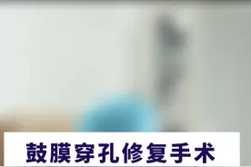 #医学科普 #郑雅丽 #鼓膜穿孔修复手术 #热点视频封面