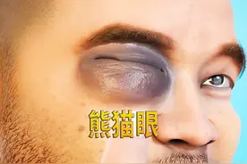 为什么被人打了会有熊猫眼呢？ #涨知识 #科普动画 #熊猫眼视频封面