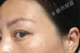 女子(@丫头nig )亲测点痣小妙招，浅表痣7天结痂脱落 可能会留坑。警告！个人肤质不同 切勿盲目跟风。视频封面