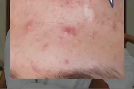 祛痘药膏分两种，一个视频讲清楚#医学科普 #皮肤 #痘痘 视频封面