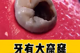 牙坏出了大洞，要咋办呢？ #牙齿 #口腔健康 #硬核健康科普行动视频封面